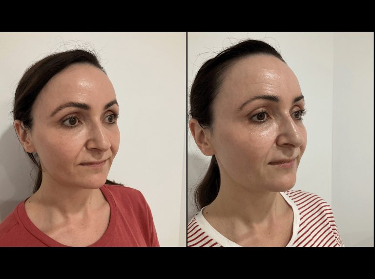 PDO thread lift results 3, before and after, female patient, angle view