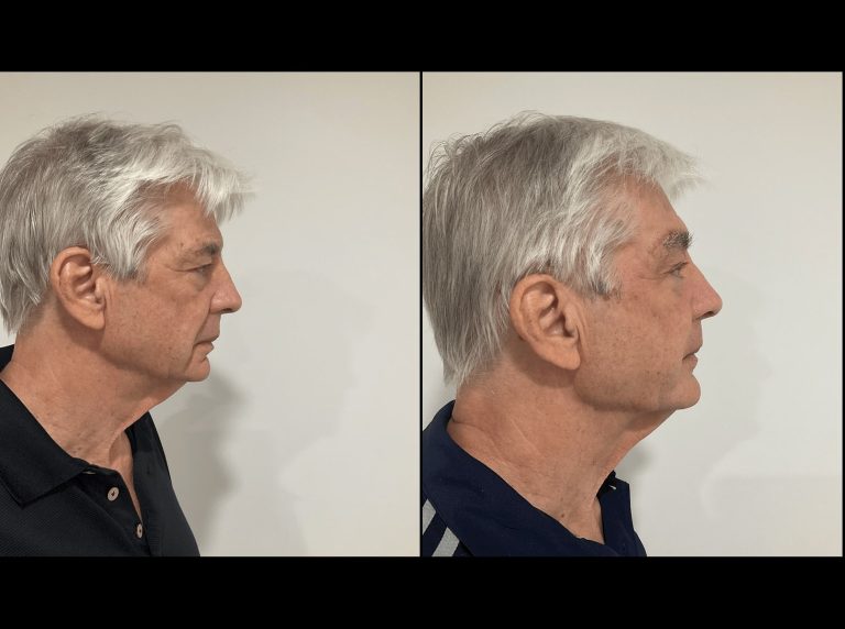 PDO thread lift, before and after 2, male patient, side view, Dr Scott Brisbane