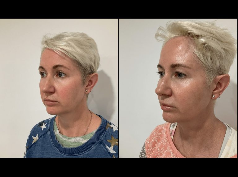PDO Thread lift patient before and after 6, angle view, Dr Scott Brisbane