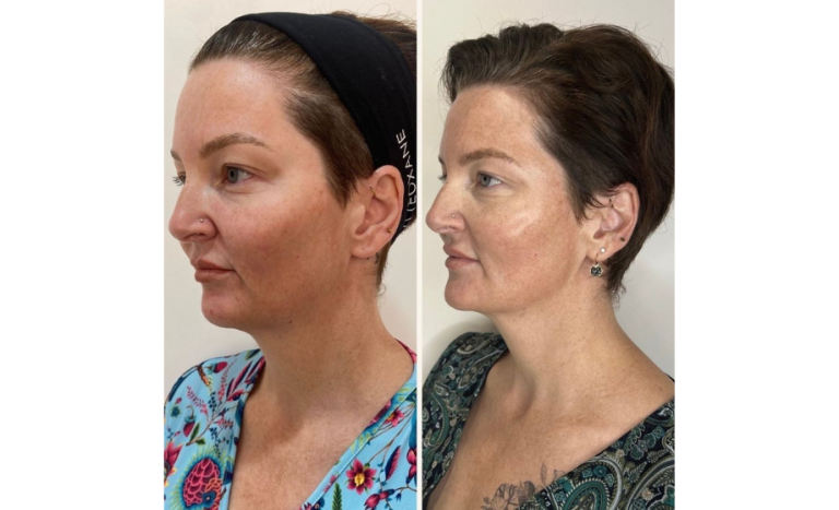 PDO thread lift in Brisbane 5-5, female patient, procedure results, angle view, Dr Scott