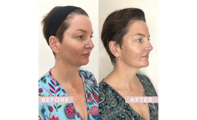 PDO Thread lift before and after 5-2, female patient, angle view, Dr Scott Brisbane