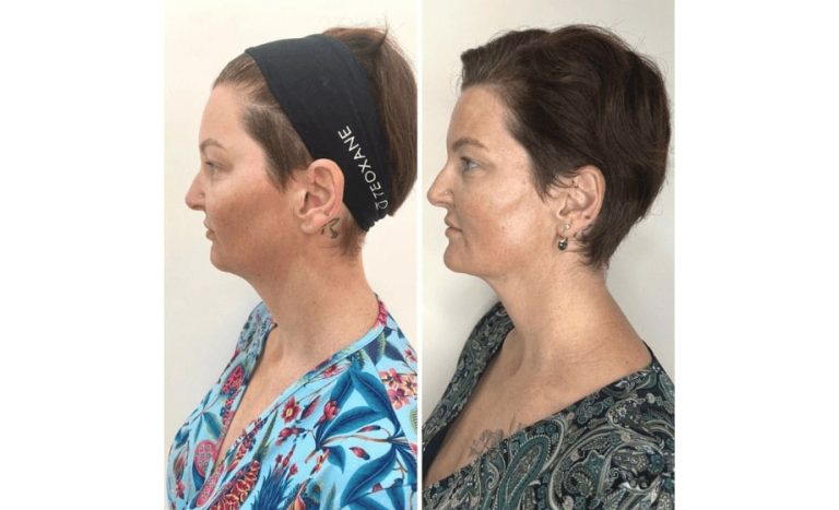 Thread lift before and after 4-2, side view, Dr Scott Brisbane