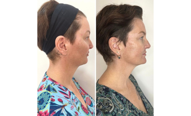 PDO Thread lift before and after (results) 5-4, female patient, right side view, Dr Scott Brisbane