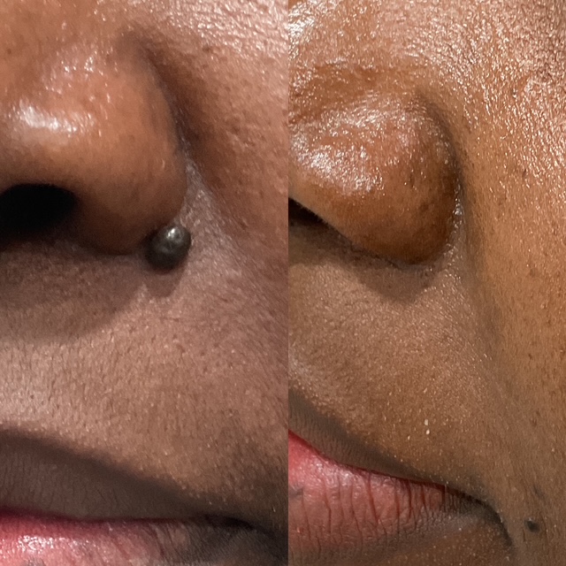Mole removal before and after 15 (close-up image), Dr Scott, Brisbane Cosmetic Physician