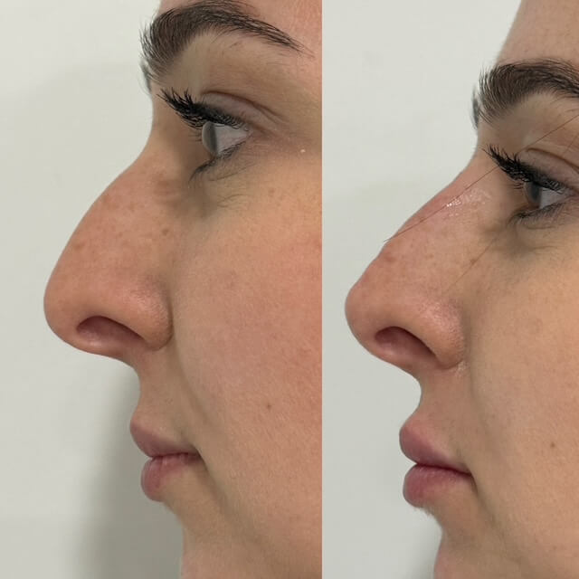 Non-surgical Rhinoplasty, before and after 17, side view, Dr Scott Brisbane