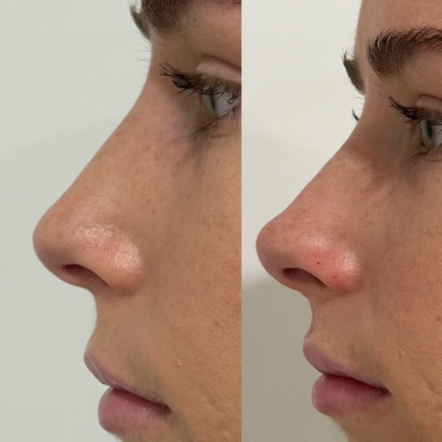 Non-surgical (liquid) Rhinoplasty results 12, Dr Scott, Brisbane Cosmetic Physician