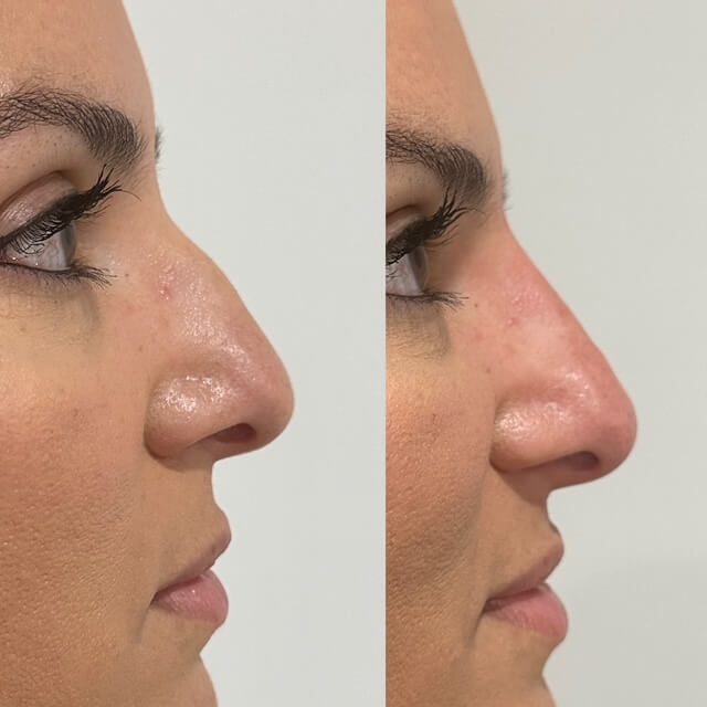 A female patient before and after non surgical Rhinoplasty (nose reshaping) 13, Dr Scott Brisbane