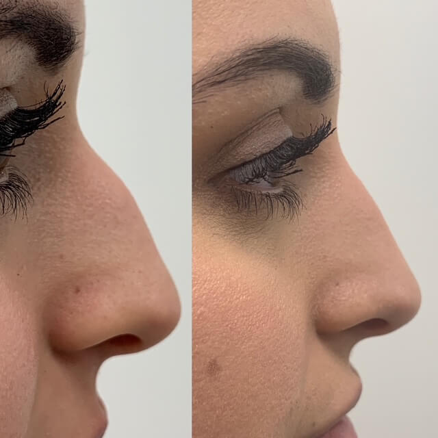 Injectable Rhinoplasty (nose job), before and after 14, Dr Scott Brisbane