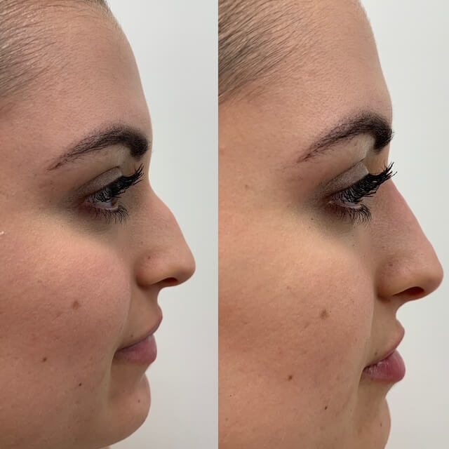 Non Surgical Rhinoplasty results (before and after) 15, side view, Dr Scott, Brisbane Cosmetic Physician