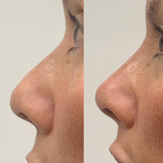 Non surgical Rhinoplasty (liquid nose job), before and after 16, side view, Dr Scott Brisbane