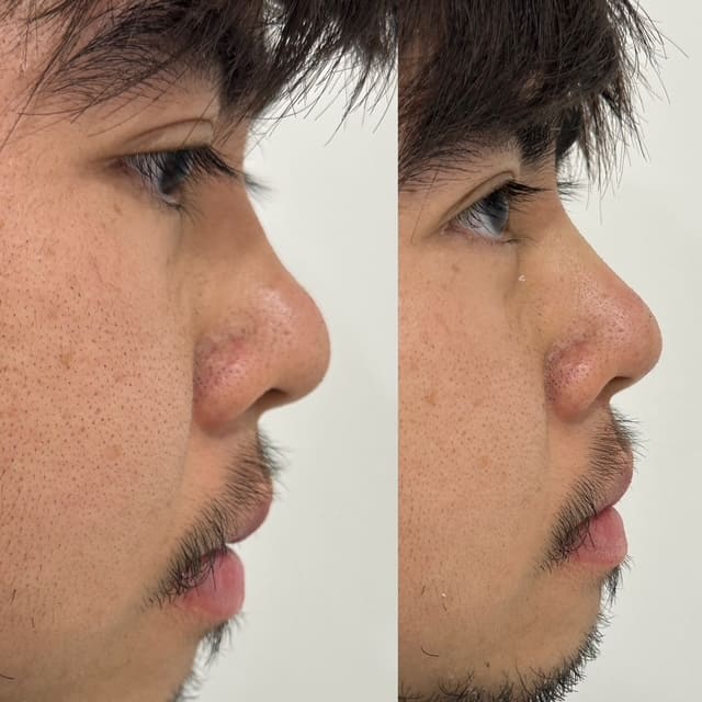 Male Nose hread lift, before and after 2-4, Dr Scott Brisbane