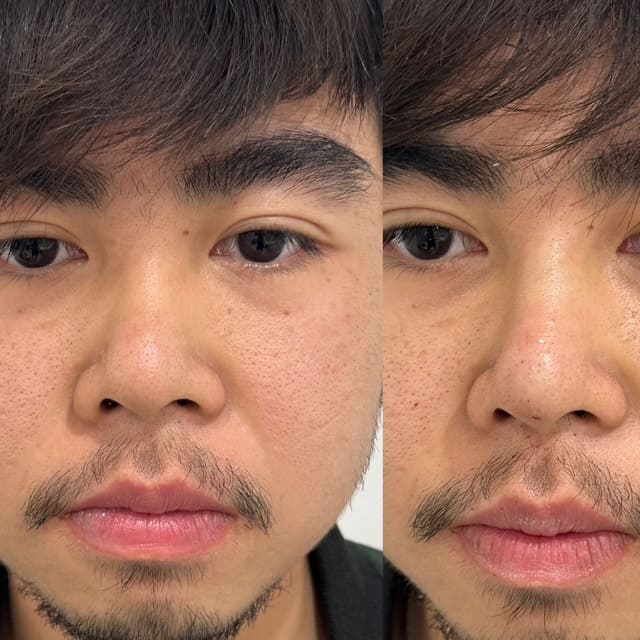 Nose thread lift results 2-3 (male patient), Dr Scott Brisbane