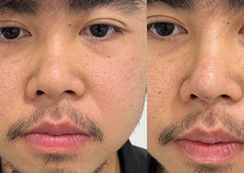 Nose thread lift before and after 1, Dr Scott Brisbane