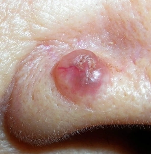 skincancerchecks-img2