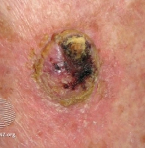 skincancerchecks-img3.webp