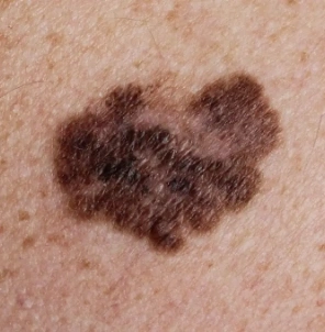 skincancerchecks-img4