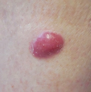 skincancerchecks-img5