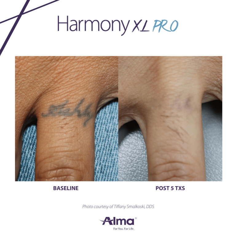 Finger tattoo removed, before and after 1, Dr Scott Brisbane