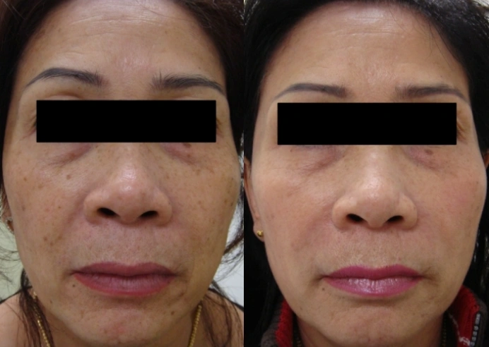 Laser Gallery - Before and After - 2