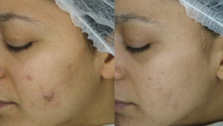 Skin Gallery - Before and After - 1